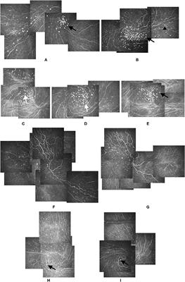 Analysis of Globular Cells in Corneal Nerve Vortex